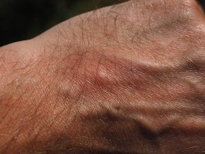 wasp stings
